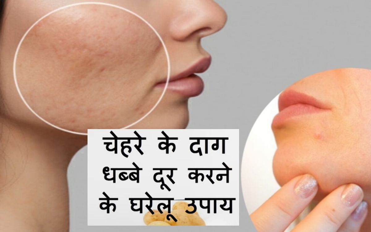 Beauty Tips: Learn easy home remedies to get rid of facial spots and get healthy glowing skin.