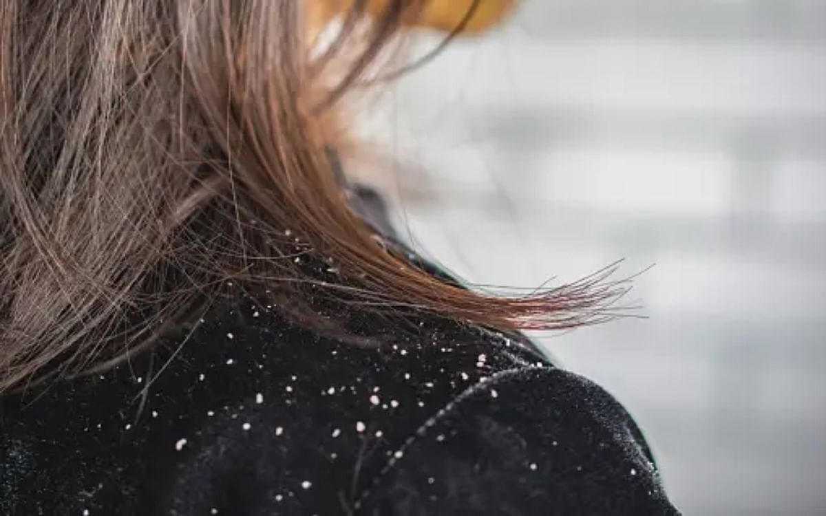 Hair Care: Dandruff troubled in the rain, try these home remedies