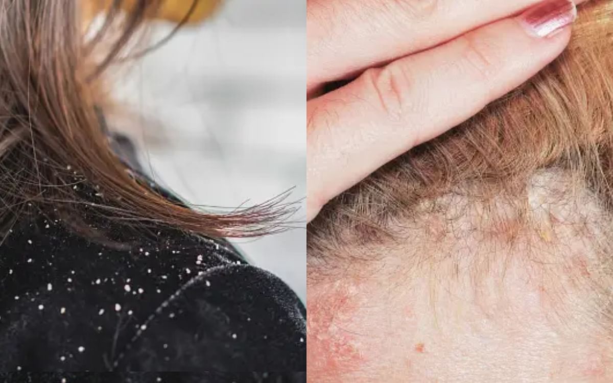 How to understand whether it is dandruff or scalp psoriasis? know the ...