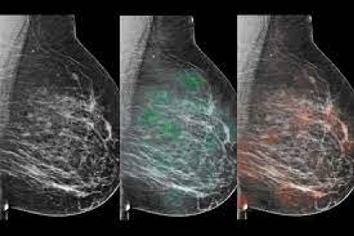 AI Mammogram: AI capable of reading breast cancer screening images, study reveals this