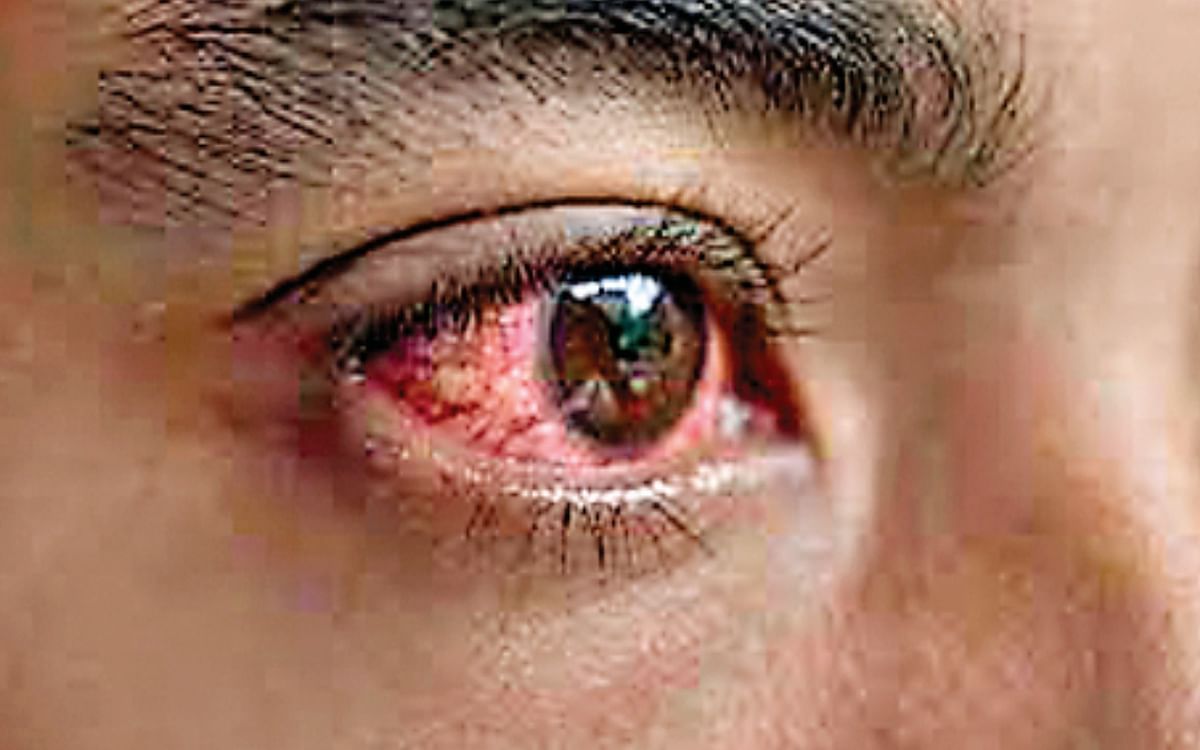 Beware of red eyes!  Conjunctivitis spreading rapidly in children, number of patients increased in hospitals