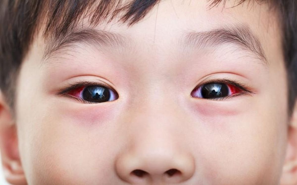 Conjunctivitis spreading rapidly, how to keep children safe, learn here