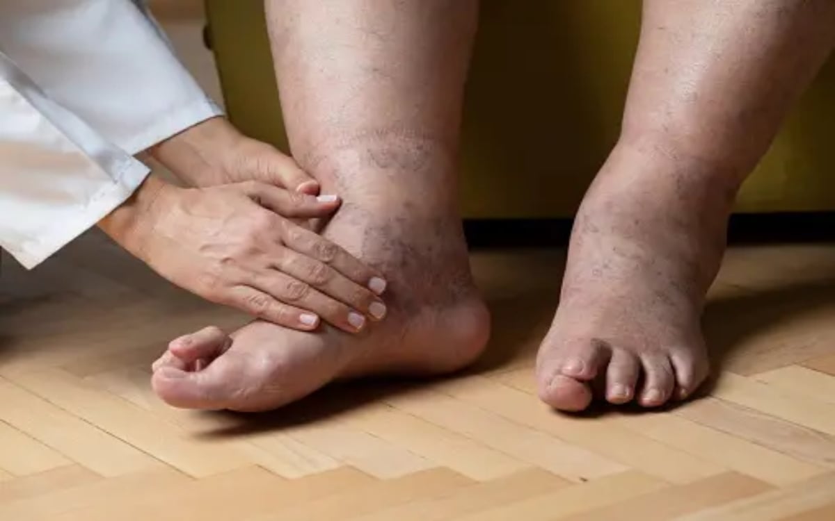 Swelling Feet Concern: Do not ignore swelling in feet, it can be the cause of many diseases.