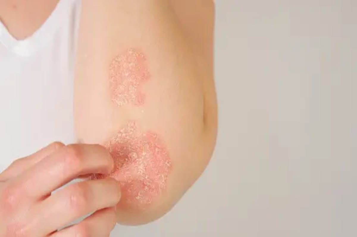 Do not ignore red rashes and itching on the skin, know the symptoms and treatment of psoriasis.
