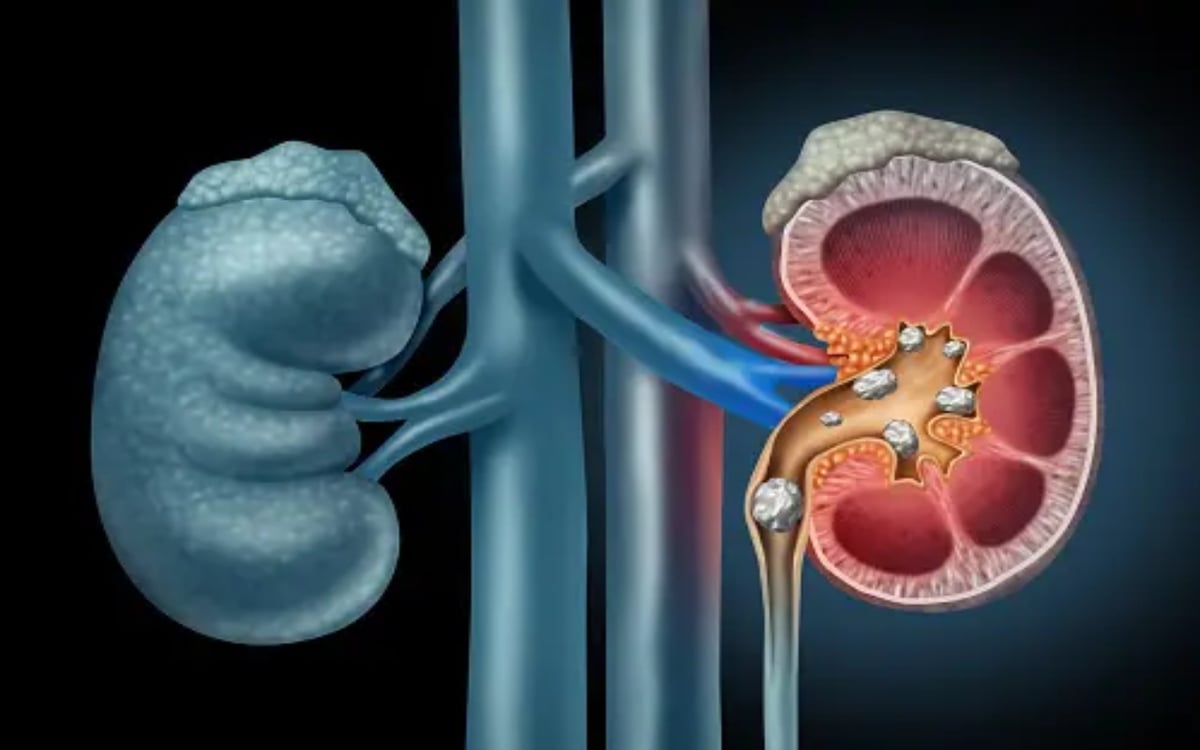 Health: Excessive calcium intake is the cause of kidney stones, know here